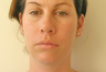 Chin Liposuction