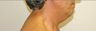 Chin Liposuction