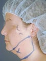 Chin Liposuction
