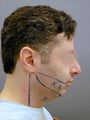 Chin / Neck Liposuction