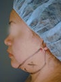 Chin / Neck Liposuction
