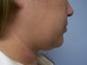 Liposuction to chin/neck area