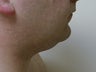 Liposuction of neck/chin area