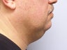 Chin/Neck Liposuction