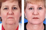 Complete facial plastic surgery, age 56