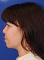 Chin Implant