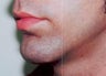 Chin augmentation using prosthesis