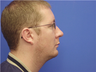 Chin Surgery