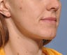 Chin Reduction