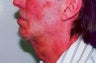 Chin Augmentation