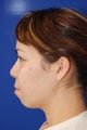 Chin Implant