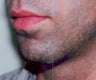 Chin augmentation using prosthesis