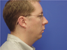Chin Surgery