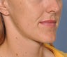 Chin Reduction