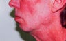Chin Augmentation