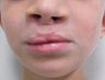 Cleft lip and palate