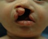 Cleft lip and palate