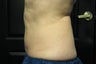 Zeltiq CoolSculpting