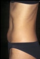CoolSculpting treatment of unwanted tummy fat