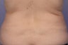 CoolSculpting to Bra Rolls/Back Fat