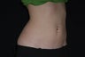 CoolSculpting