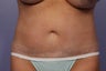 CoolSculpting to Abdomen