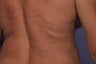 CoolSculpting to Bra/Back Rolls