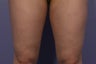 CoolSculpting Inner Thighs