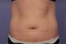 CoolSculpting to Abdomen