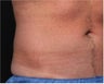 NonInvasive Fat Removal with CoolSculpting -Invented by Dr. Dieter Manstein