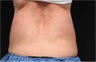 NonInvasive Fat Removal with CoolSculpting -Invented by Dr. Dieter Manstein