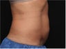 NonInvasive Fat Removal with CoolSculpting - Invented by Dr. Dieter Manstein