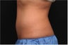 NonInvasive Fat Removal with CoolSculpting - Invented by Dr. Dieter Manstein
