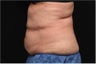 NonInvasive Fat Removal with CoolSculpting - Invented by Dr. Dieter Manstein