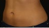 Coolsculpting-lower abdomen
