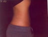 Coolsculpting Treatment