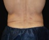 CoolSculpting on love handle and flank areas