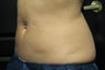 Zeltiq CoolSculpting