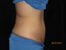 Coolsculpting