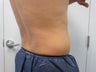 CoolSculpting
