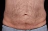 CoolSculpting
