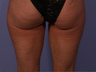 CoolSculpting to Banana Roll, Upper Posterior Thighs