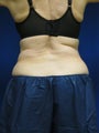 Coosculpting