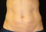 CoolSculpting