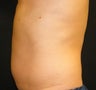 CoolSculpting