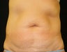 CoolSculpting