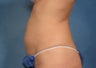 CoolSculpting by ZELTIQ