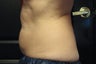 Zeltiq CoolSculpting