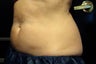 Zeltiq CoolSculpting