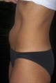 CoolSculpting treatment of unwanted tummy fat